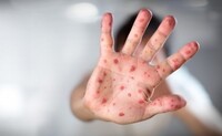 Количество случаев возросло в 20 раз: в МОЗ обеспокоены ситуацией с заболеваемостью корью
